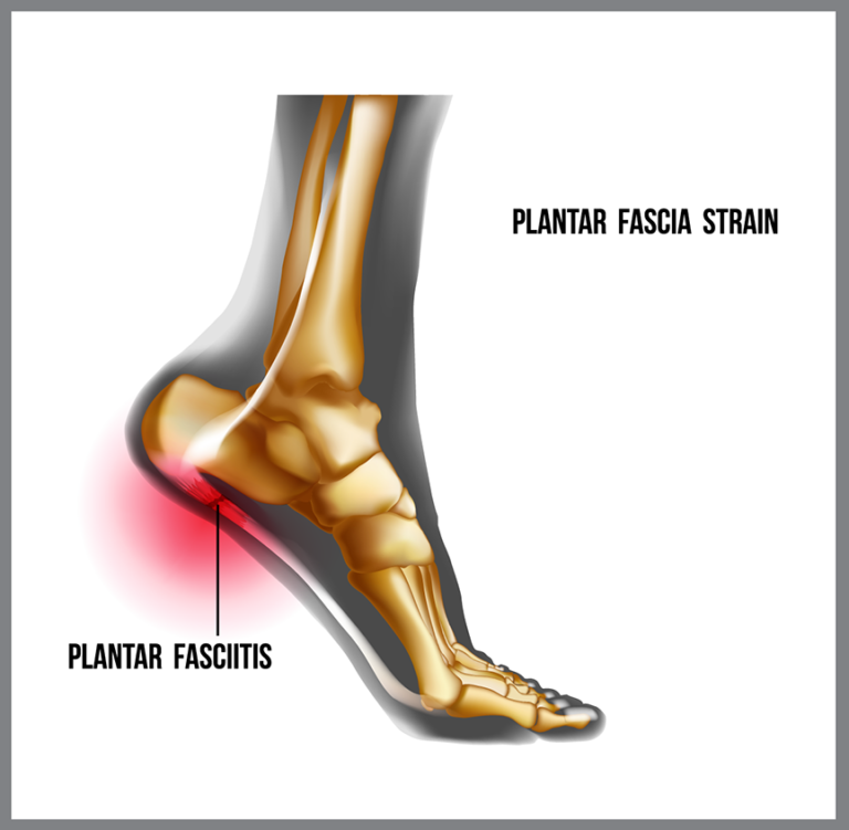 Plantar Fasciitis What Is It And Do I Have It • Scerbo Physical Therapy 