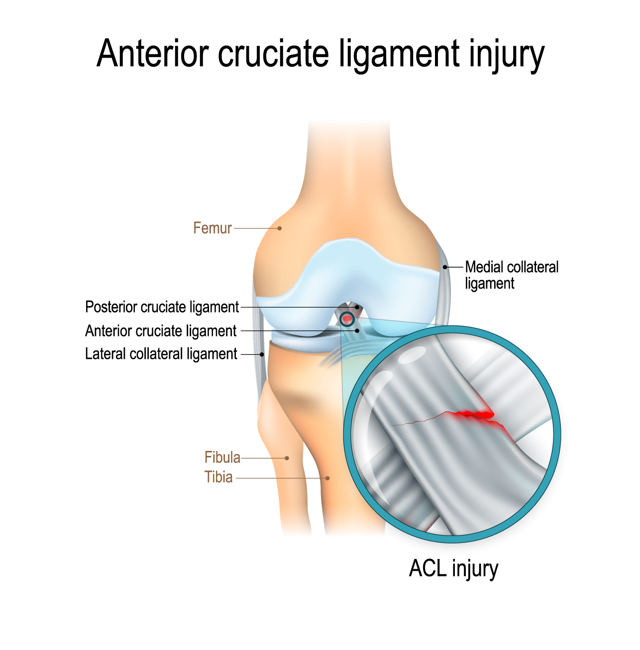 acl-tears-of-the-knee-pt-can-help-scerbo-physical-therapy