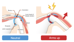 Illustration of shoulder impingement comparing neutral position versus arms up rotation