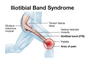 Iliotibial Band Syndrome (ITBS) anatomy diagram overview showing knee pain and inflammation area